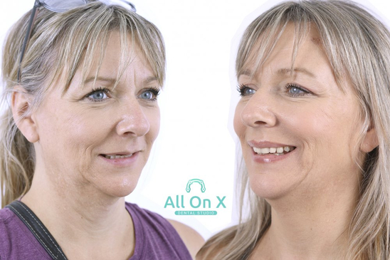 Slider image (9) All on X Dental Studio: Leading Dental Clinic in Los Algodones